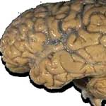 Анемия головного мозга и его оболочек