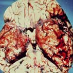 Воспаление головного мозга и его оболочек