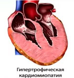 Кардиомиопатия у собак